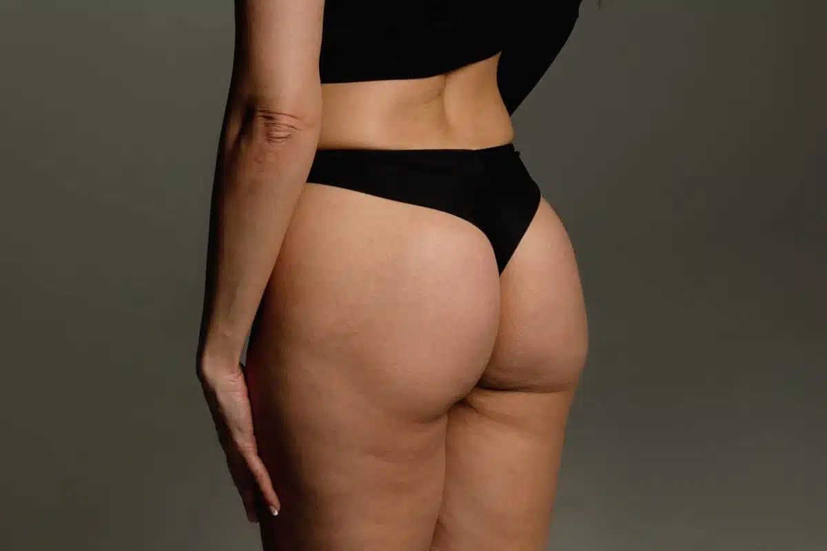La liposuccion est-elle une solution à la cellulite ? | Clinique Bellefontaine | Lausanne